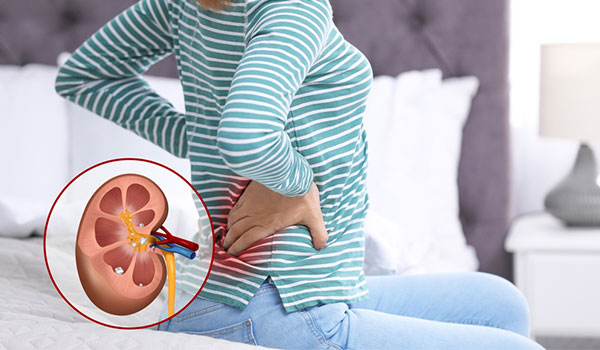 kidney-stone-management-in-eluru