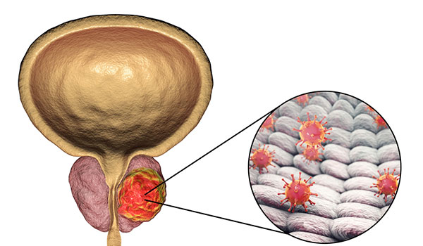 urological-cancers-in-eluru